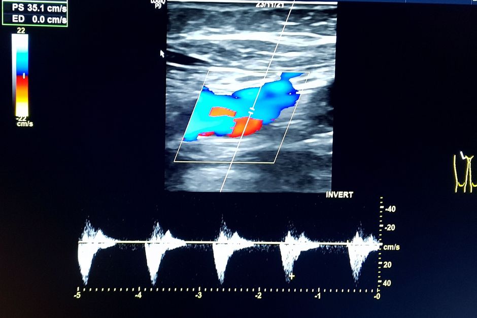 Sonographie der Gefäße - hier die Beine