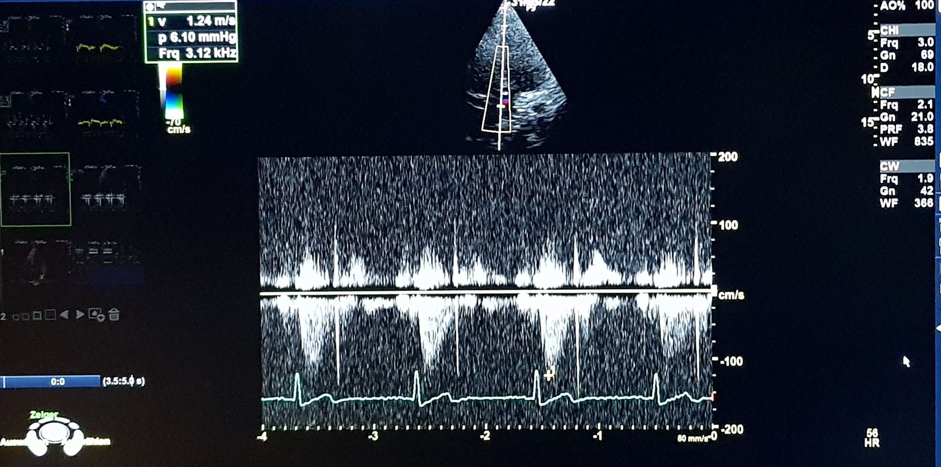 Echokardiographie EKG Herzultraschall