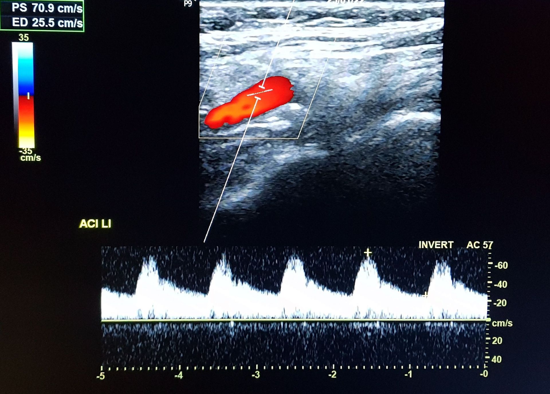 Sonographie der Gefäße - hier die Halsschlagader