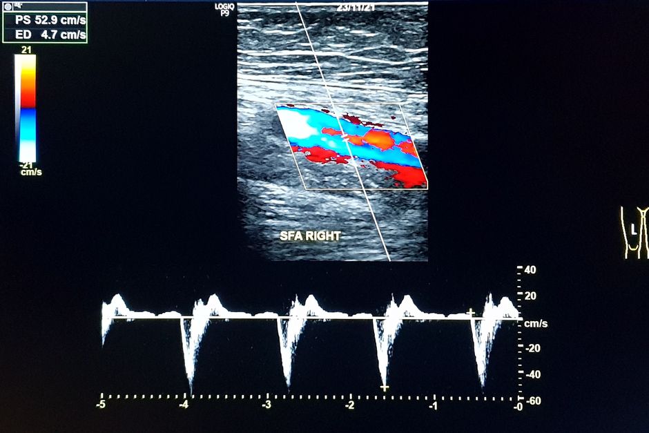 Sonographie der Gefäße - hier die Beine
